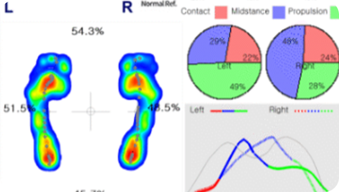 보행분석검사 이미지